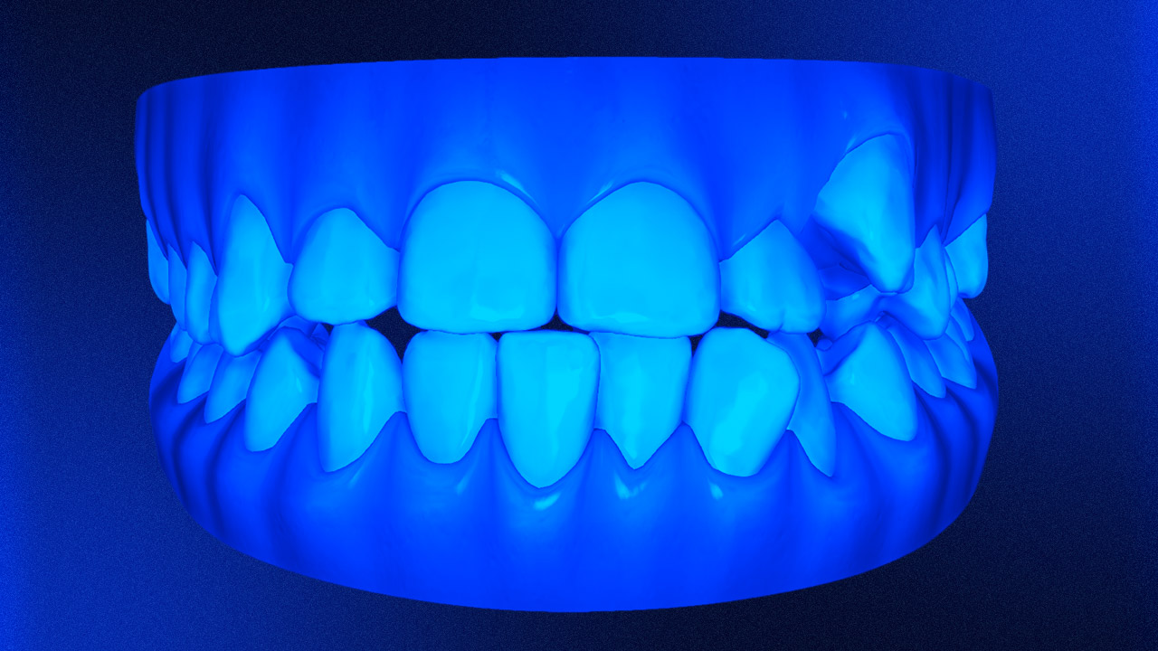 Premium Clinical Deep Dive Class Iii Open Bite