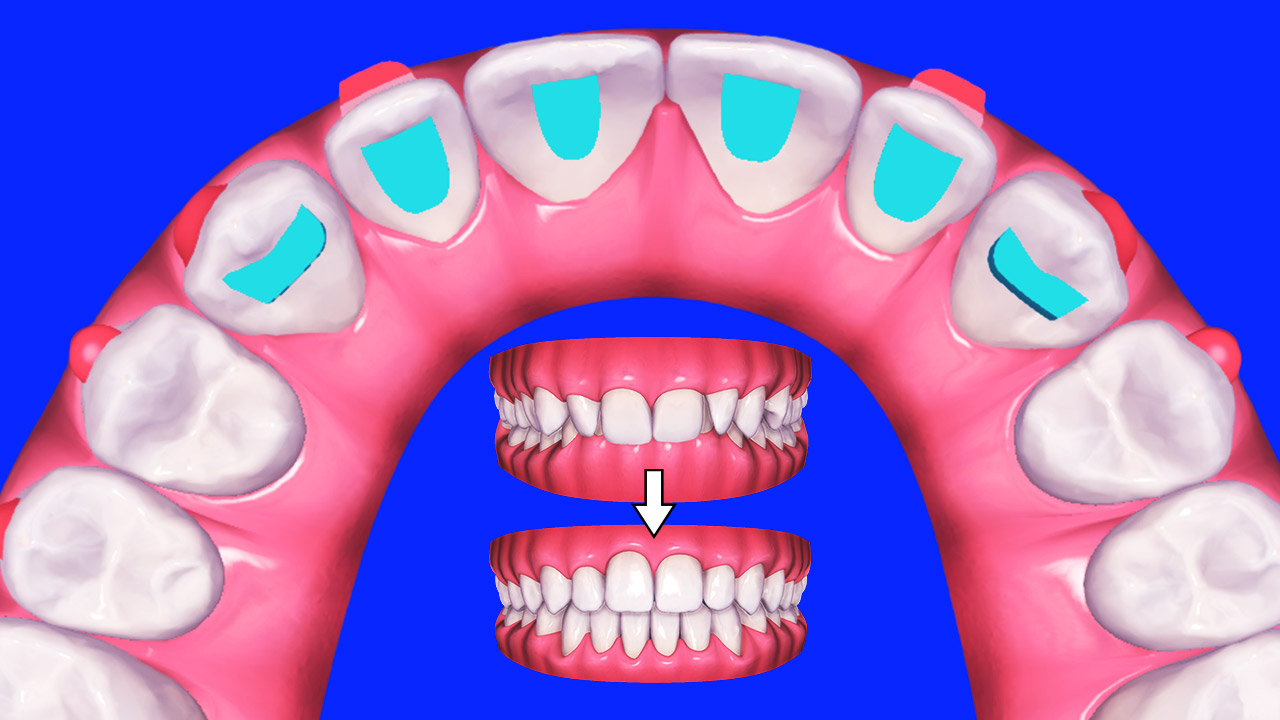 Anterior Bite Ramps Biomechanics