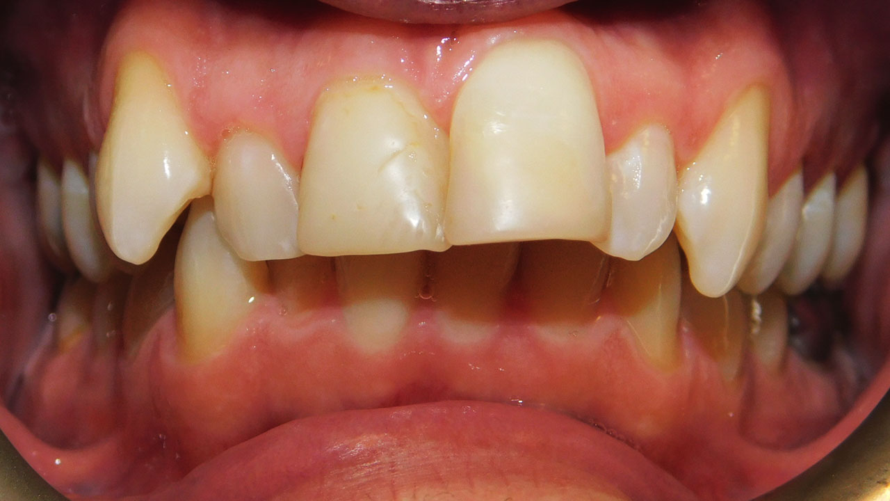 Class II Division 1 Malocclusion Excessive Overjet and Deep Bite