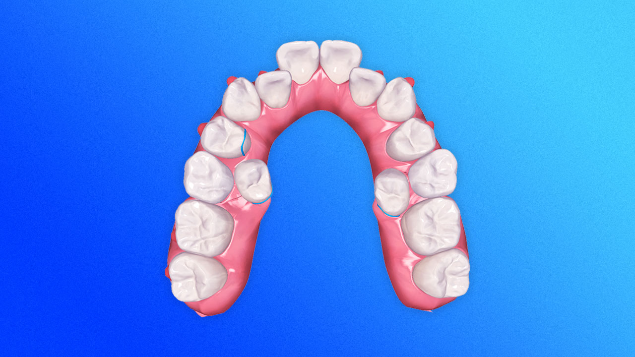 Using Adjuncts In Clear Aligner Treatment To Manage Difficult Movements