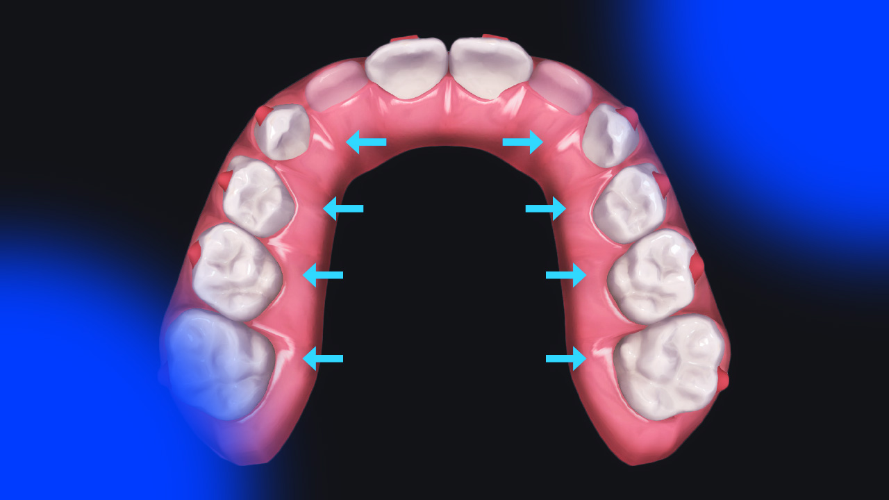 clear-aligner-treatment-of-the-transverse-dimension-invisalign-bite