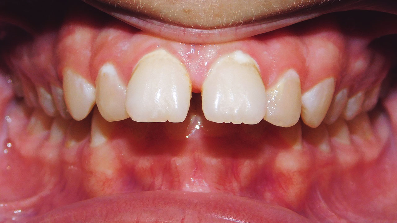 Class Ii Division I Malocclusion Excessive Overjet And Overbite Upper Arch Spacing Case Gallery 5014