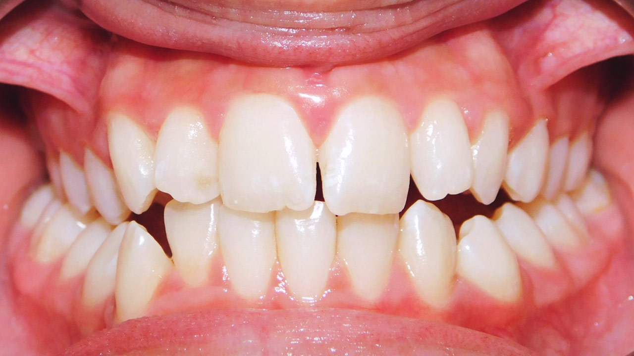 Class Iii Malocclusion Anterior And Lateral Open Bite Posterior