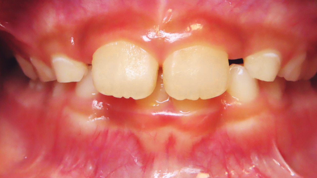 Class II Division 1 Malocclusion, Excessive Overjet, Deep Overbite ...