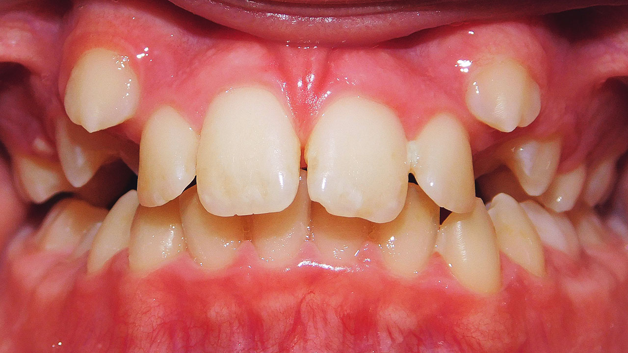 Class I Malocclusion, Class II Tendency, Excess Overjet, Deep Overbite ...