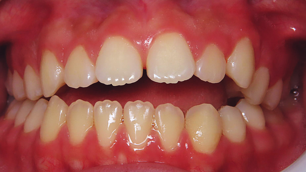 Cc419 Class Iii Malocclusion With Anterior Crossbite - vrogue.co