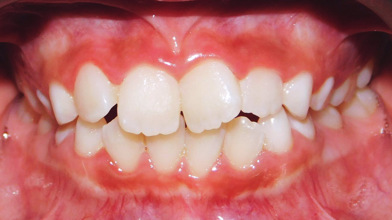 Class I Malocclusion, Early Mixed Dentition, Dental Crowding, Narrow