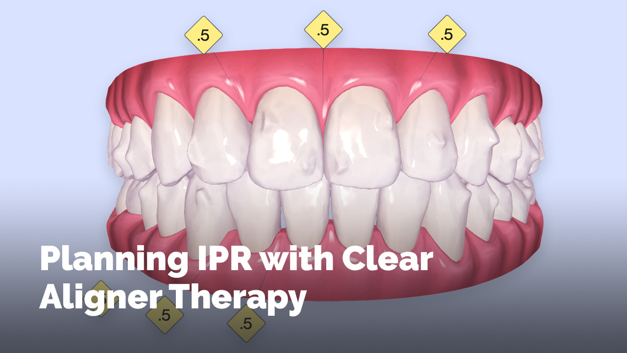 [Premium] Planning IPR with Clear Aligner Therapy Invisalign Immersion