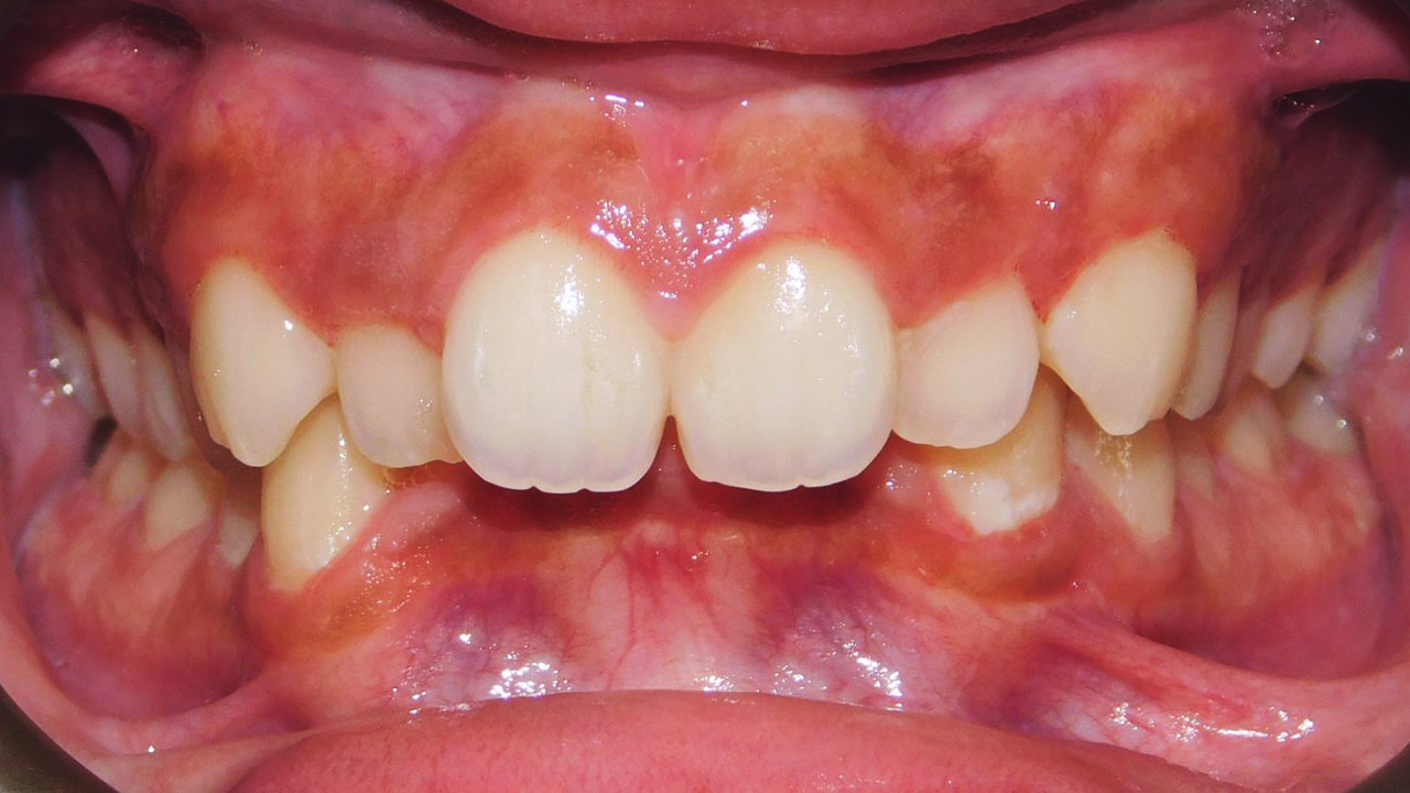 Class Ii Malocclusion Excessive Overjet Deep Overbite Convex Profile Dental Crowding Case