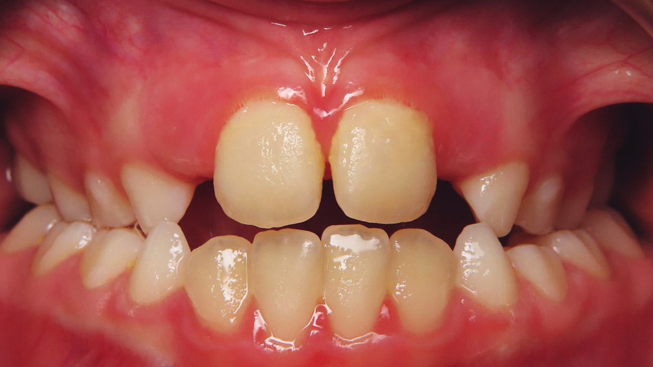 Class I Malocclusion, Early Mixed Dentition, Bilateral Posterior