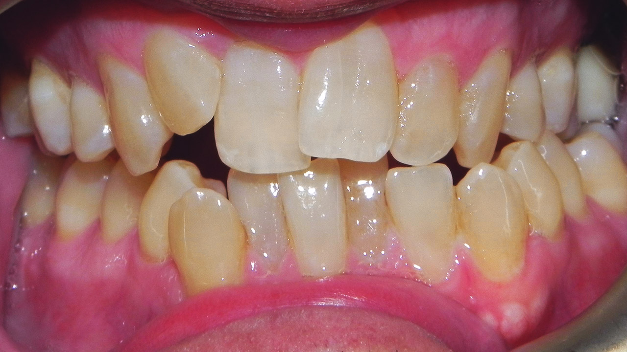 Class II Molar, Class III Canine Malocclusion, High Angle, Excessive ...