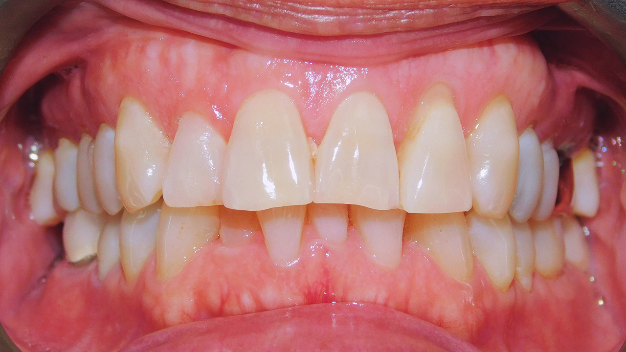 Class I Malocclusion, Severe Lower Crowding, Missing Teeth, Excessive 