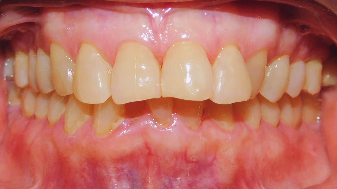 Class I Malocclusion Excessive Overjet Upper Incisor Proclination Deep Overbite Case Gallery 2522