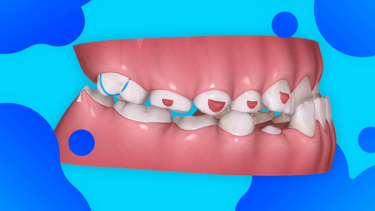 [Premium] Class III Clear Aligner Therapy in the Early Mixed Dentition