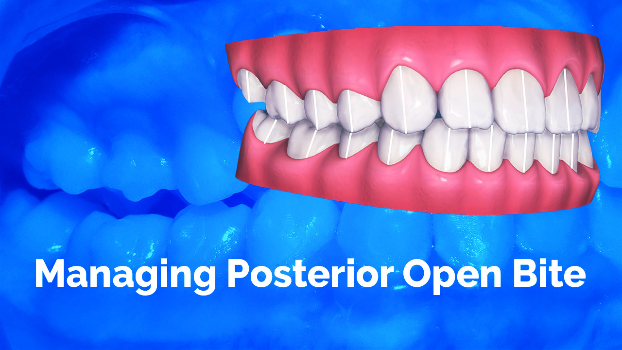 [Premium] Managing Posterior Open Bite - Invisalign Immersion