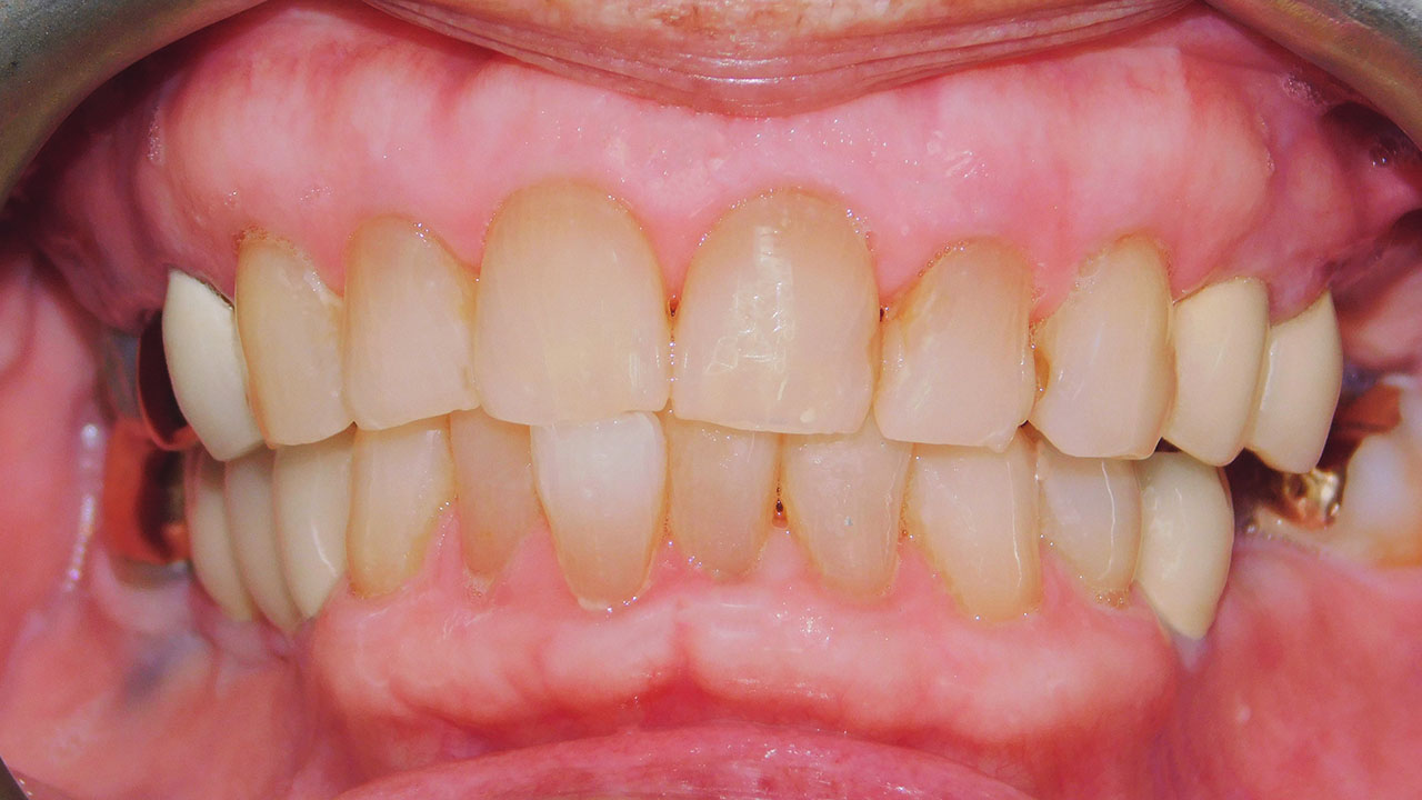 Class III Malocclusion, Class I Canine Position, Multiple Missing Teeth ...