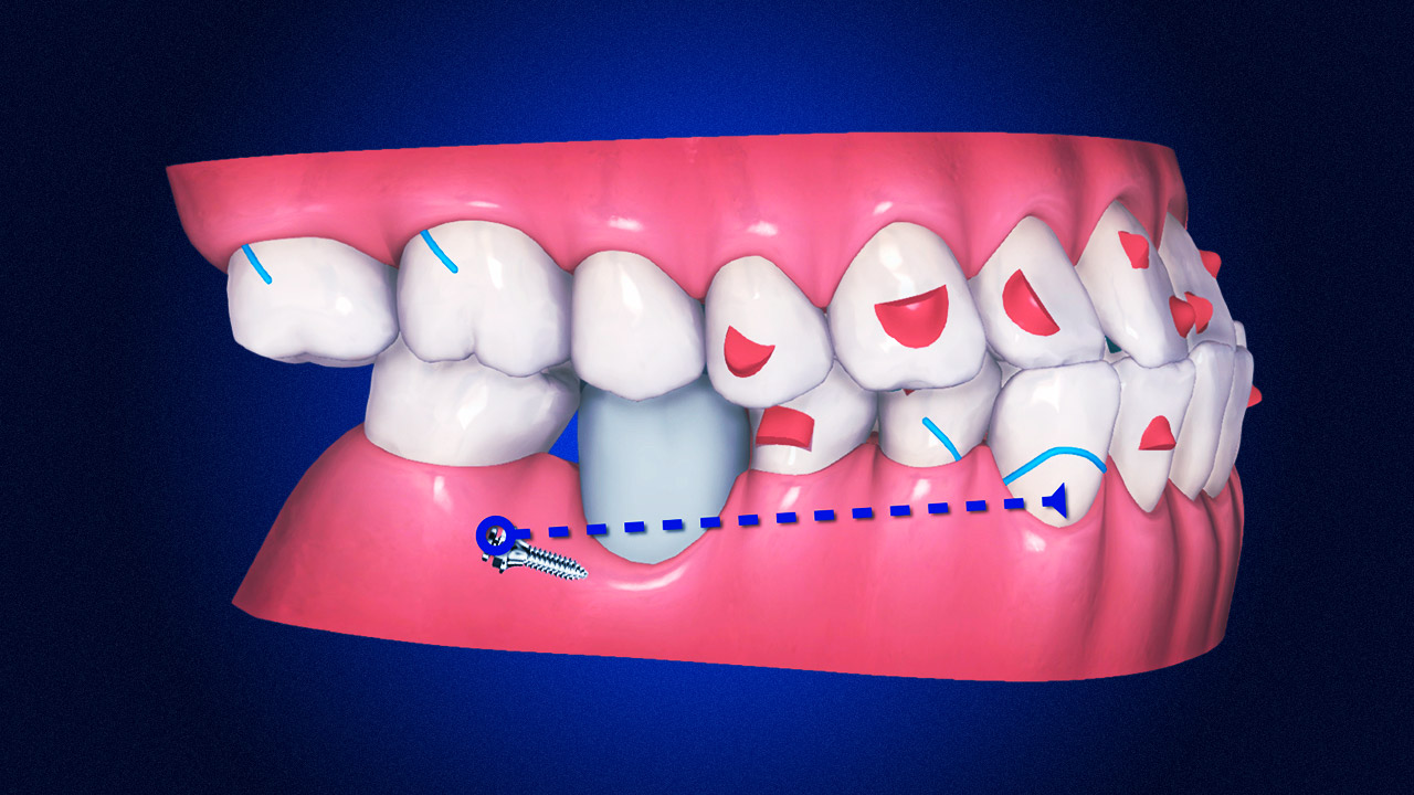 Using TADs with Clear Aligner Treatment - Biomechanics