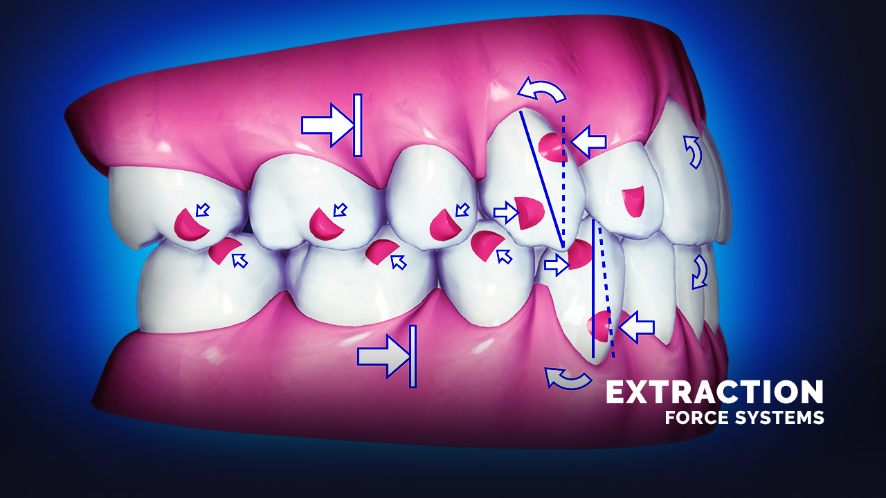 [Premium] Force Systems for Extraction Therapy - Invisalign Extraction